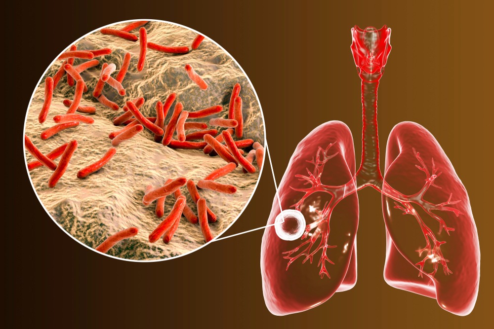 Fibrous-cavernous,Pulmonary,Tuberculosis,And,Close-up,View,Of,Mycobacterium,Tuberculosis,Bacteria,